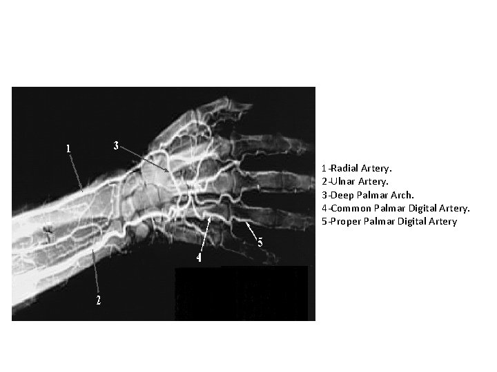 1 -Radial Artery. 2 -Ulnar Artery. 3 -Deep Palmar Arch. 4 -Common Palmar Digital