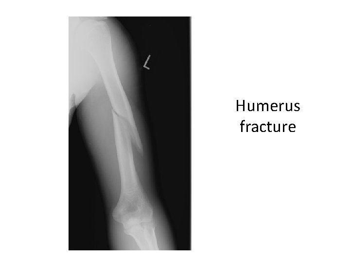 Humerus fracture 