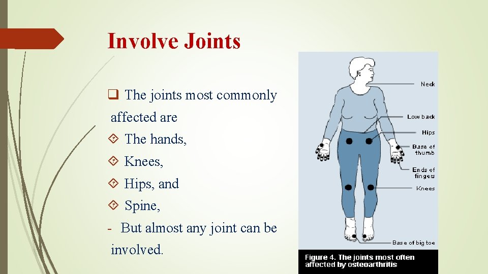 Involve Joints q The joints most commonly affected are The hands, Knees, Hips, and