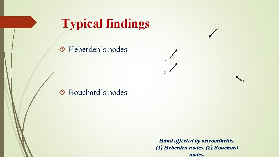 Typical findings Heberden’s nodes 1 2 2 Bouchard’s nodes Hand affected by osteoarthritis. (1)