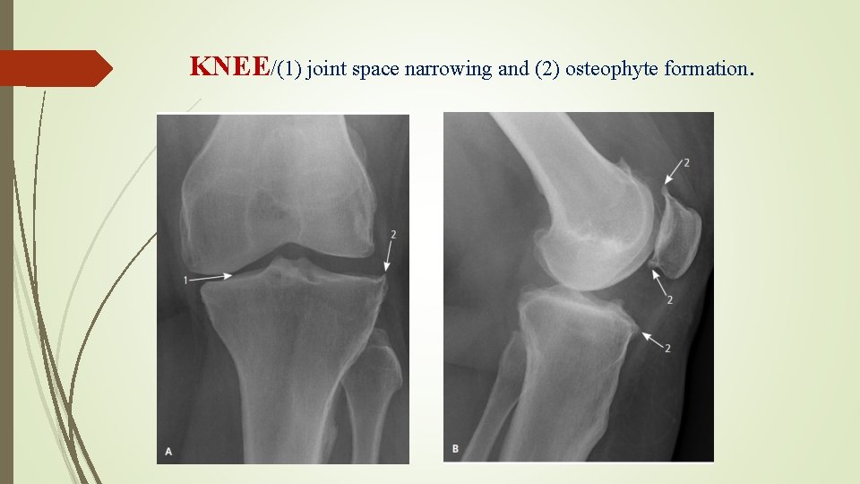KNEE/(1) joint space narrowing and (2) osteophyte formation. 