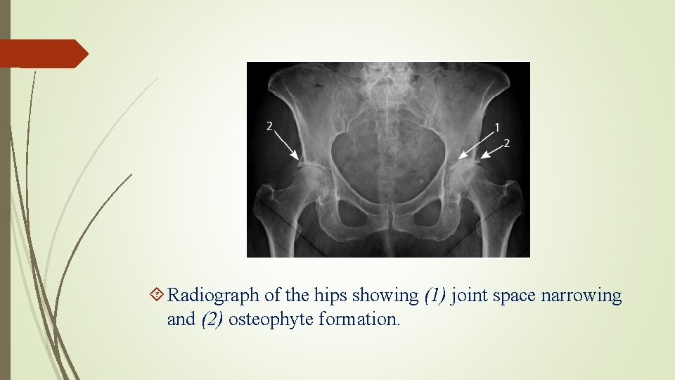  Radiograph of the hips showing (1) joint space narrowing and (2) osteophyte formation.