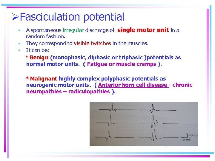 ØFasciculation potential • • • A spontaneous irregular discharge of single motor random fashion.