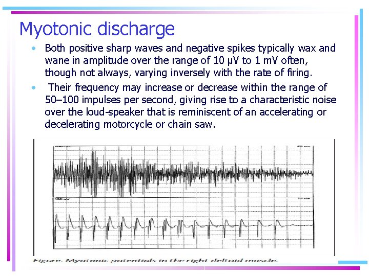 Myotonic discharge • Both positive sharp waves and negative spikes typically wax and wane