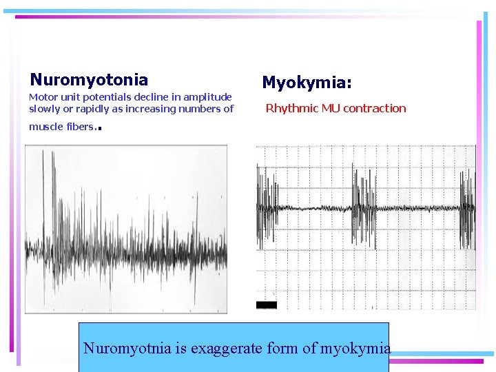 Nuromyotonia Motor unit potentials decline in amplitude slowly or rapidly as increasing numbers of