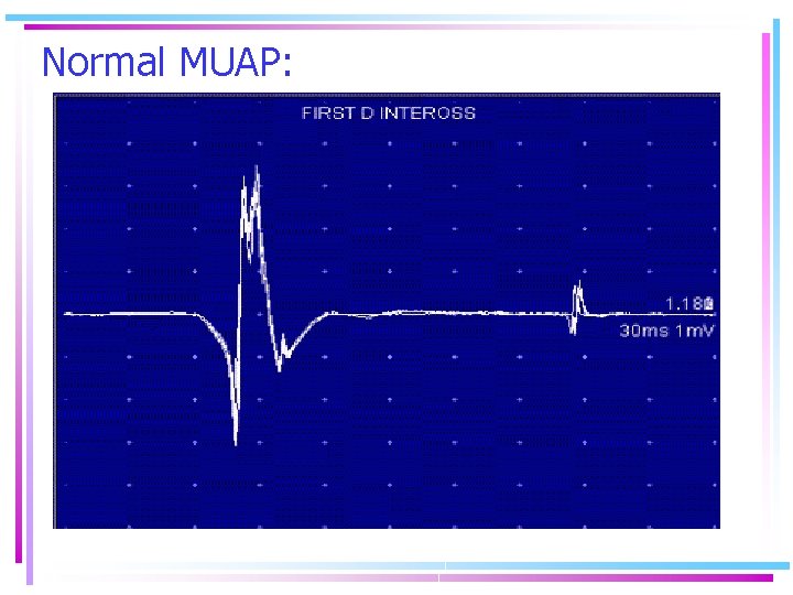 Normal MUAP: 