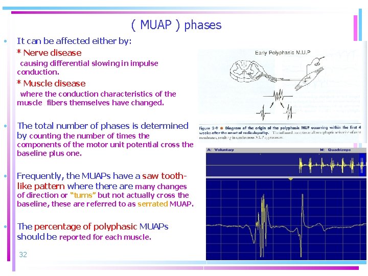 ( MUAP ) phases • It can be affected either by: * Nerve disease
