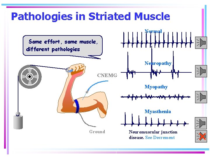 Pathologies in Striated Muscle Normal Same effort, same muscle, different pathologies Neuropathy CNEMG Myopathy