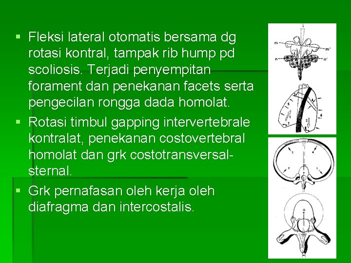 § Fleksi lateral otomatis bersama dg rotasi kontral, tampak rib hump pd scoliosis. Terjadi