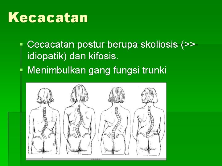 Kecacatan § Cecacatan postur berupa skoliosis (>> idiopatik) dan kifosis. § Menimbulkan gang fungsi