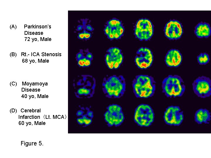 (A) Parkinson’s Disease 72 yo, Male (B) Rt. - ICA Stenosis 68 yo, Male