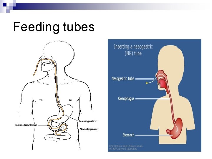 Feeding tubes 