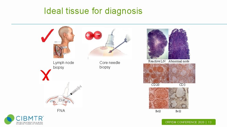 Ideal tissue for diagnosis Lymph node biopsy Core needle biopsy Reactive LN CD 20