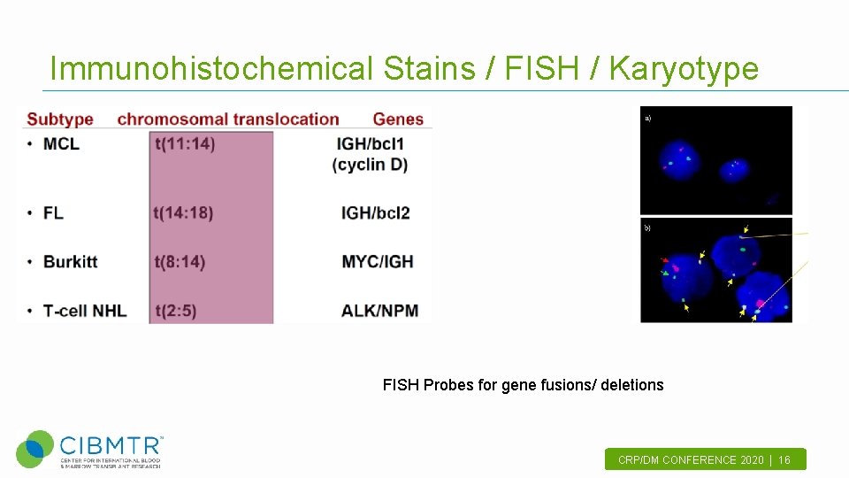 Immunohistochemical Stains / FISH / Karyotype FISH Probes for gene fusions/ deletions CRP/DM CONFERENCE