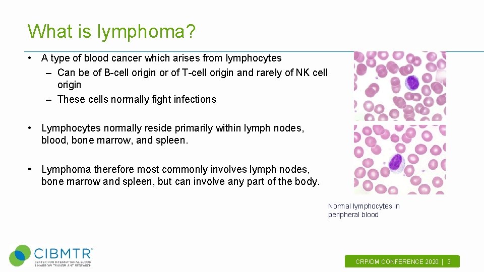 What is lymphoma? • A type of blood cancer which arises from lymphocytes –