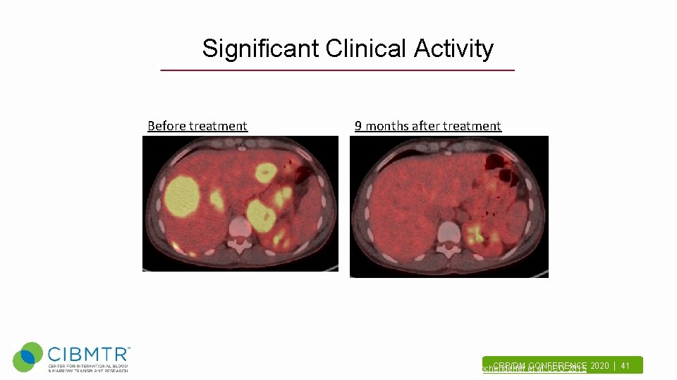 Significant Clinical Activity Before treatment 9 months after treatment CRP/DM et CONFERENCE Kochenderfer al,