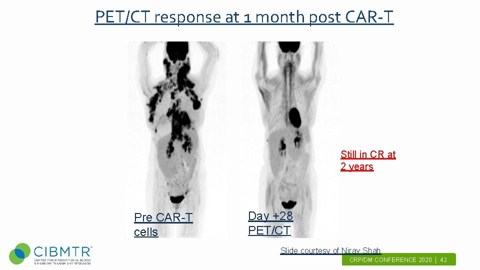 PET/CT response at 1 month post CAR-T Still in CR at 2 years Pre