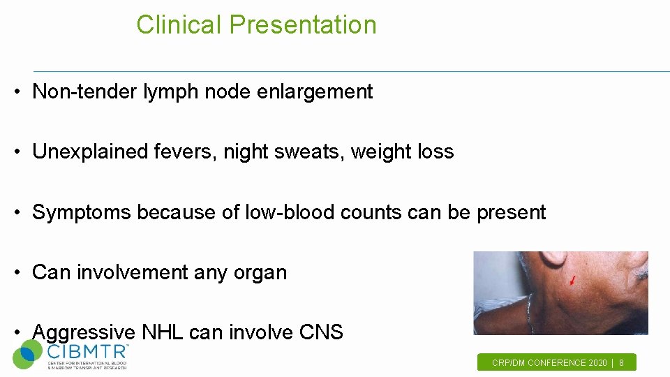 Clinical Presentation • Non-tender lymph node enlargement • Unexplained fevers, night sweats, weight loss