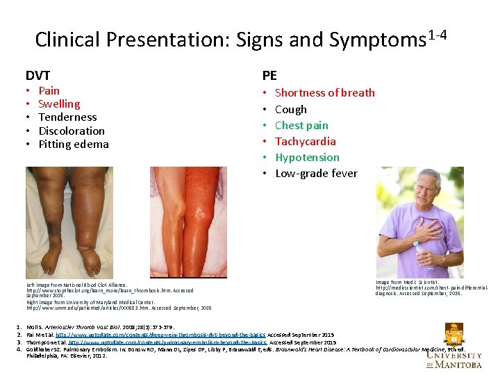 Clinical Presentation: Signs and Symptoms 1 -4 DVT • • • Pain Swelling Tenderness