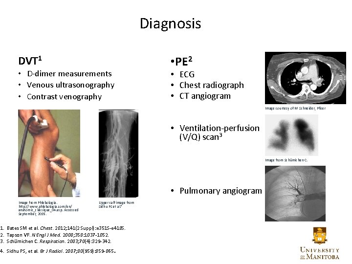 Diagnosis DVT 1 • D-dimer measurements • Venous ultrasonography • Contrast venography • PE