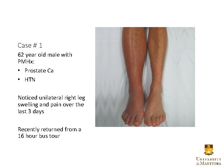 Case # 1 62 year old male with PMHx: • Prostate Ca • HTN