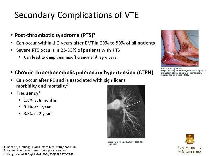 Secondary Complications of VTE • Post-thrombotic syndrome (PTS)1 • Can occur within 1 -2