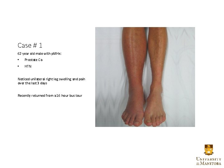 Case # 1 62 year old male with p. MHx: • Prostate Ca •