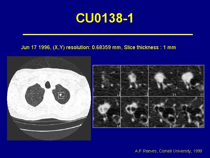 CU 0138 -1 Jun 17 1996, (X, Y) resolution: 0. 68359 mm, Slice thickness