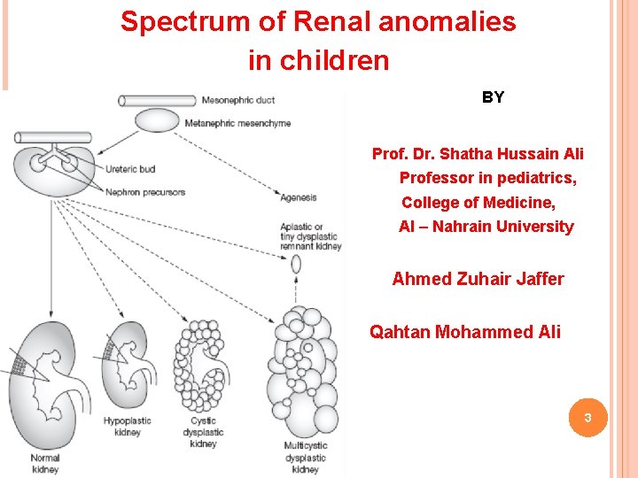 2 Spectrum of Renal anomalies in children BY