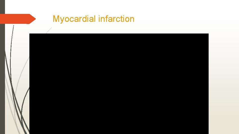 Myocardial infarction 