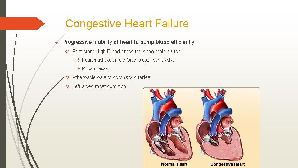 Congestive Heart Failure Progressive inability of heart to pump blood efficiently Persistent High Blood