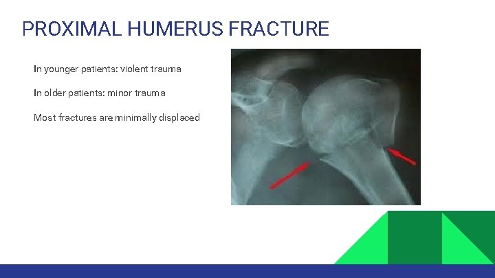 PROXIMAL HUMERUS FRACTURE In younger patients: violent trauma In older patients: minor trauma Most