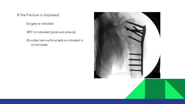 If the fracture is displaced: Surgery is indicated. ORIF is indicated (plate and screws).