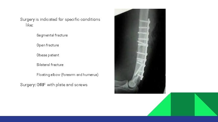Surgery is indicated for specific conditions like: • • • Segmental fracture Open fracture