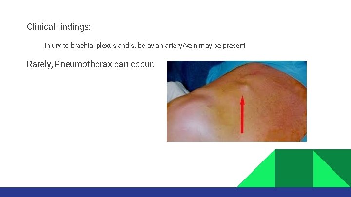 Clinical findings: Injury to brachial plexus and subclavian artery/vein may be present Rarely, Pneumothorax