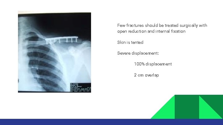 Few fractures should be treated surgically with open reduction and internal fixation Skin is