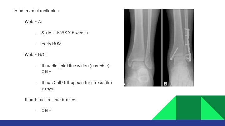 Intact medial malleolus: Weber A: • • Splint + NWB X 6 weeks. Early