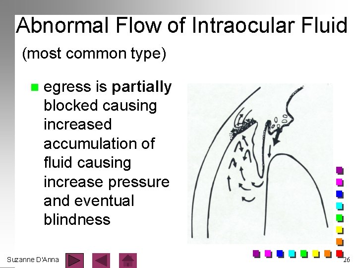 Abnormal Flow of Intraocular Fluid (most common type) n egress is partially blocked causing