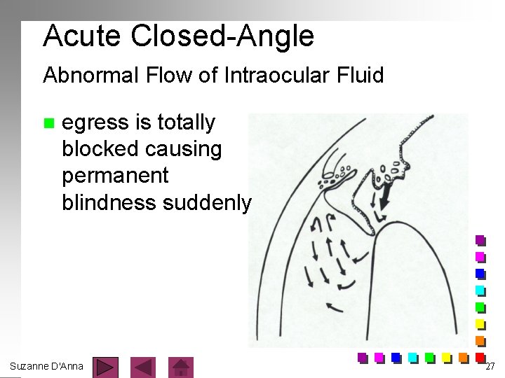 Acute Closed-Angle Abnormal Flow of Intraocular Fluid n egress is totally blocked causing permanent