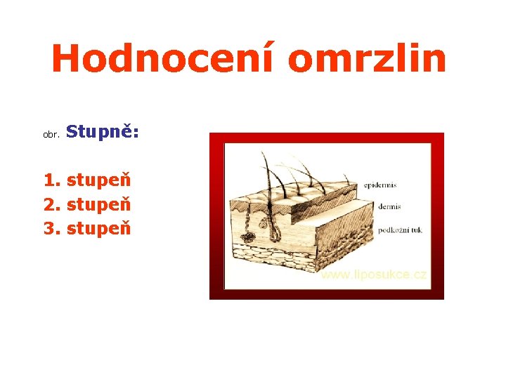 Hodnocení omrzlin obr. Stupně: 1. stupeň 2. stupeň 3. stupeň 