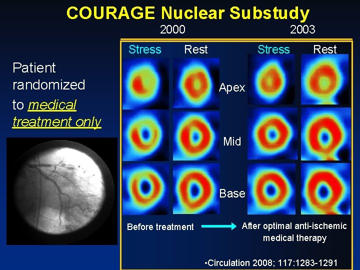 COURAGE Nuclear Substudy 2000 Stress 2003 Rest Patient randomized to medical treatment only Stress