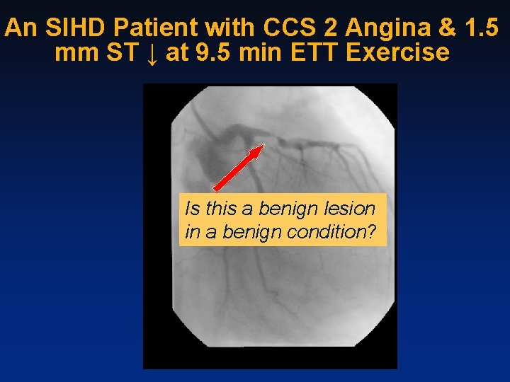 An SIHD Patient with CCS 2 Angina & 1. 5 mm ST ↓ at