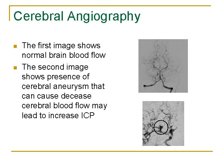 Cerebral Angiography n n The first image shows normal brain blood flow The second