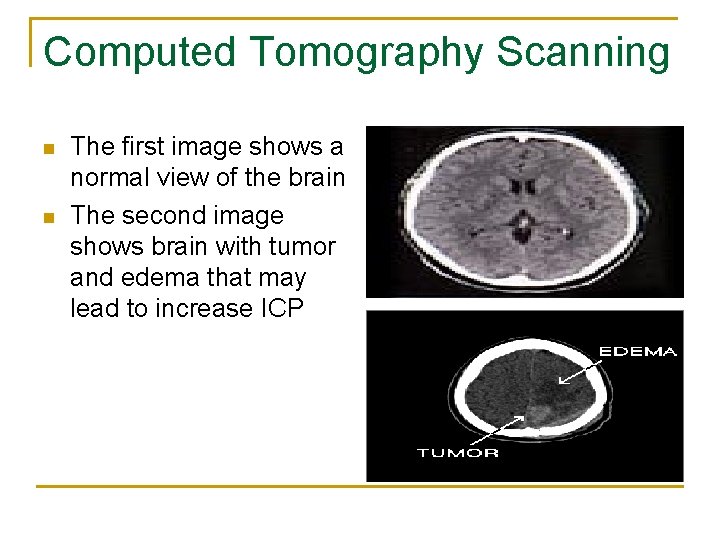 Computed Tomography Scanning n n The first image shows a normal view of the