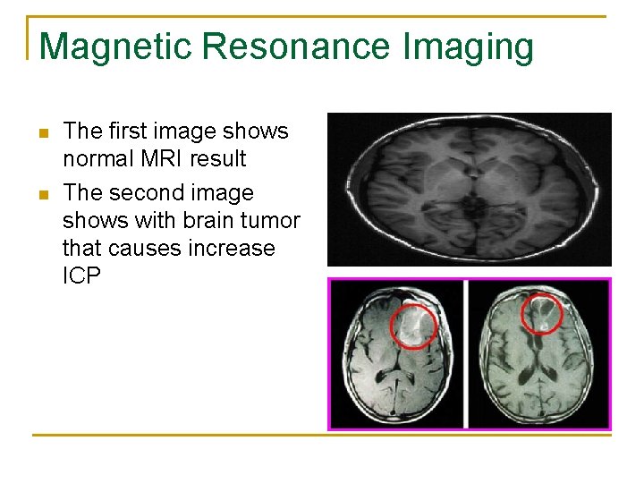 Magnetic Resonance Imaging n n The first image shows normal MRI result The second