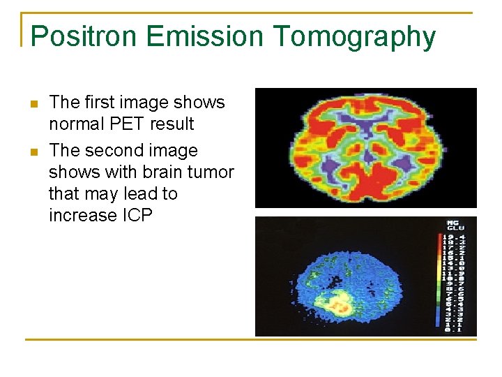 Positron Emission Tomography n n The first image shows normal PET result The second