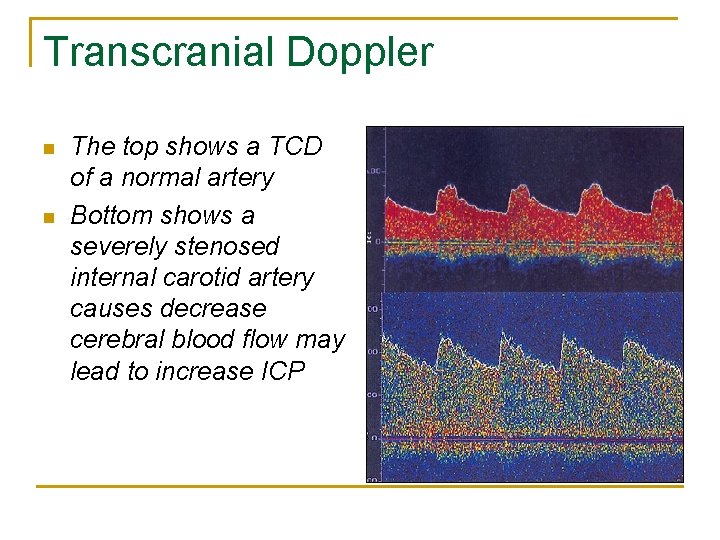 Transcranial Doppler n n The top shows a TCD of a normal artery Bottom