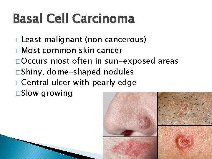 Basal Cell Carcinoma � Least malignant (non cancerous) � Most common skin cancer �