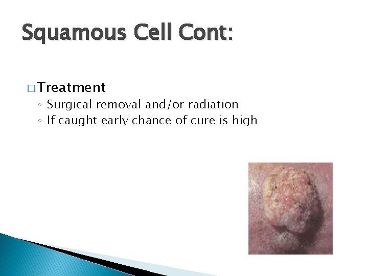 Squamous Cell Cont: � Treatment ◦ Surgical removal and/or radiation ◦ If caught early