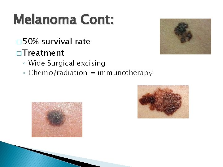 Melanoma Cont: � 50% survival rate � Treatment ◦ Wide Surgical excising ◦ Chemo/radiation